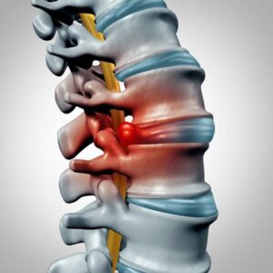 Bulging Disc vs. Herniated Disc: What the Difference Means for Your Treatment